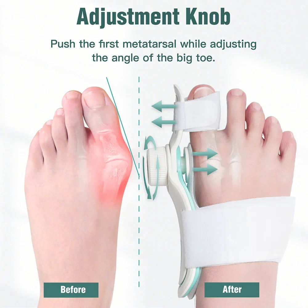 Bunion Corrector – Adjustable Hallux Valgus Orthotics Big Toe Straightener with 3-Angle Fixing Plate