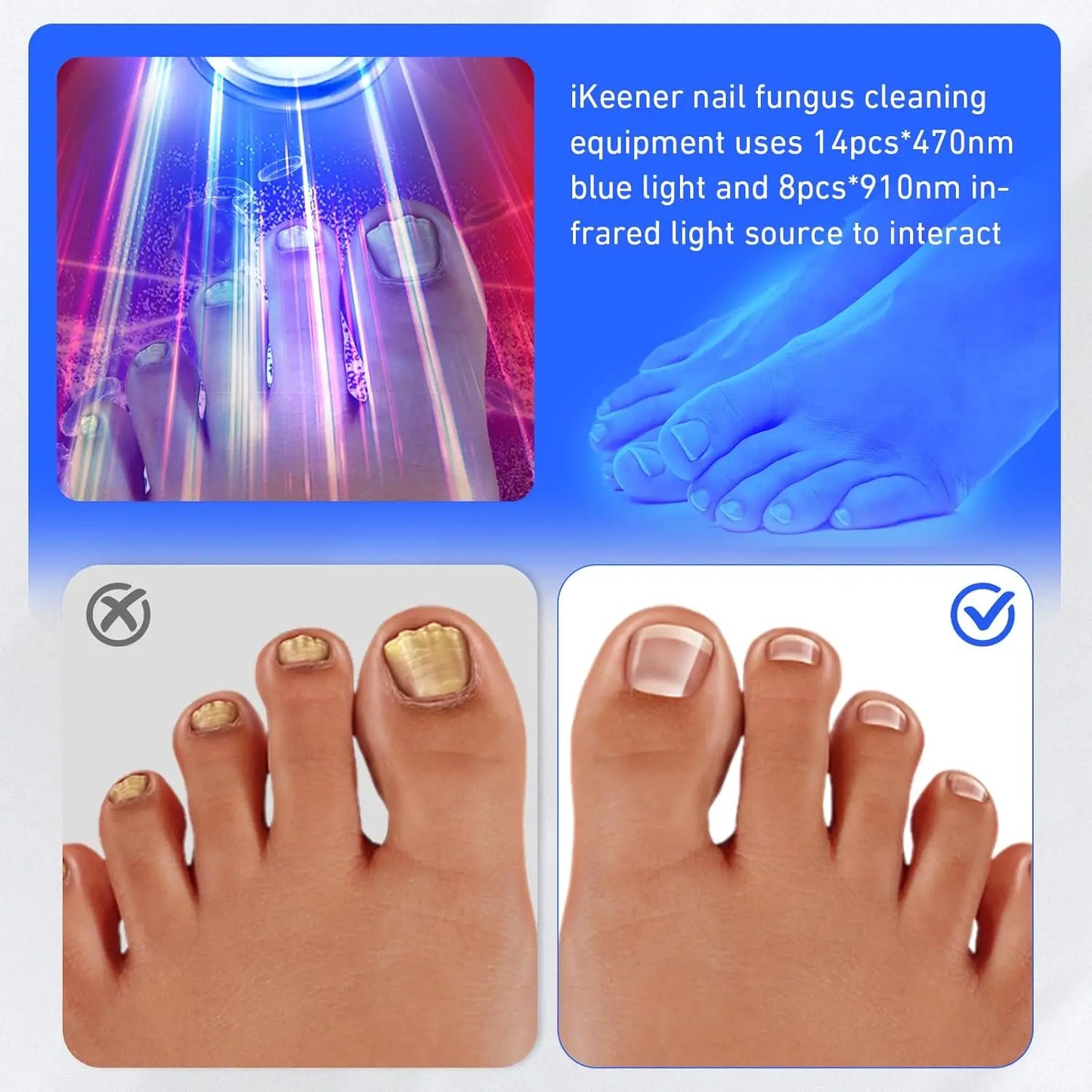 Wireless Nail Fungus Laser Treatment Device
