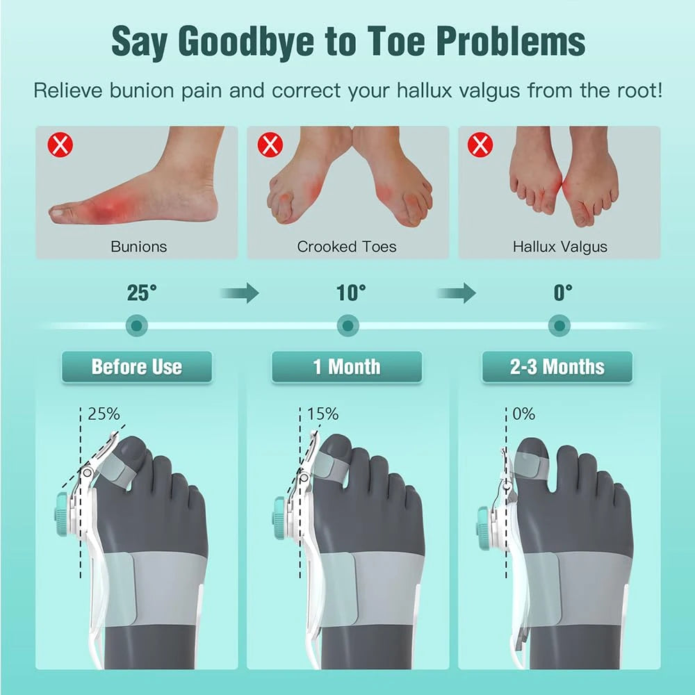 Adjustable Bunion Corrector – Hallux Valgus Toe Straightener & Orthopedic Foot Alignment Splint