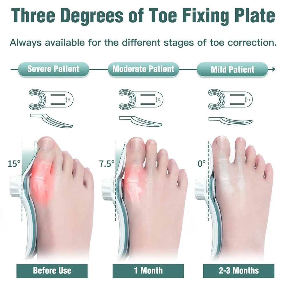 Bunion Corrector – Adjustable Hallux Valgus Orthotics Big Toe Straightener with 3-Angle Fixing Plate