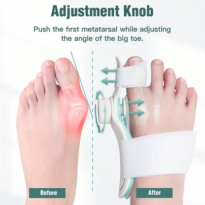 Bunion Corrector – Adjustable Hallux Valgus Orthotics Big Toe Straightener with 3-Angle Fixing Plate